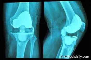 Study Shows Acupuncture Reduces Pain and Opioid Use for Total Knee Replacement Surgery Patients