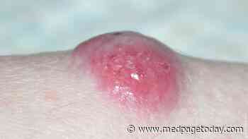 Case: VEGFR Inhibition in Merkel Cell Carcinoma Patient