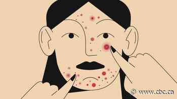 In the COVID era, nobody seems to care about my acne – me least of all