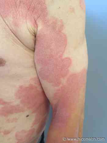 Vous souffrez de psoriasis? Il existe des traitements performants pour vous soulager