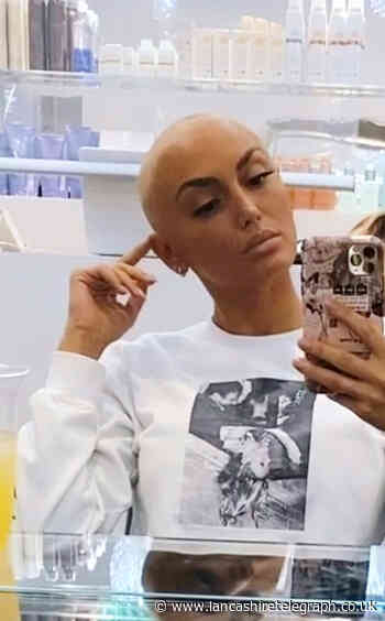 Lancashire TV star using new therapy in bid to regrow hair