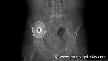Arterial Chemo Tops Chemoembolization for Large Liver Tumors