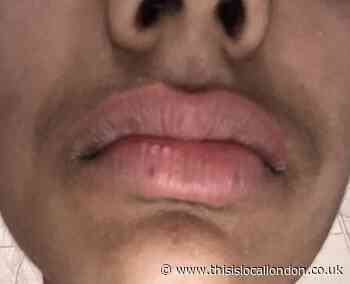 Parents go nuts after daughter has an allergic reaction in local restaurant by Maryam Meschi- James Allen’s Girls’ School