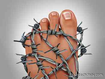Burning, Tingling and Pain in Your Feet? You May Have Small Fiber Neuropathy