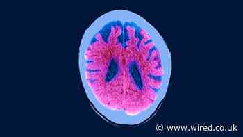 A New Dementia Test Raises More Questions Than Answers