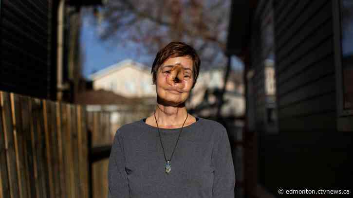 'I put life on hold:' Woman who had delayed surgery in Alberta says she's worse off