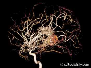 Unexpected Discovery: Vascular Defects Appear to Underlie the Progression of Parkinson’s Disease