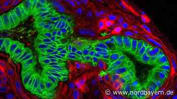 Welt-Pankreaskrebstag will aufklären: "Es ist nicht immer gleich ein Todesurteil" - Nordbayern.de
