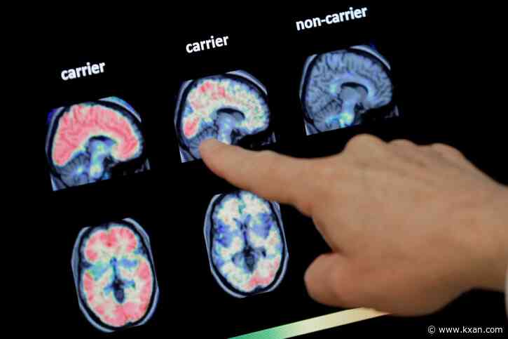 Alzheimer's Awareness: Important questions to ask and common misconceptions