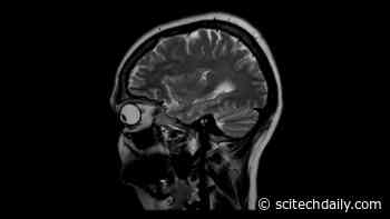 Specialized MRI Shows Autism Changes Brain’s White Matter Significantly