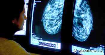 Studies that shaped Canada’s breast cancer screening guidelines ‘flawed,’ researchers say