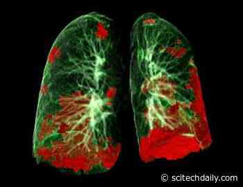 Lung Autopsies of COVID-19 Patients Reveal How Virus Spreads and Damages Tissue, Treatment Clues