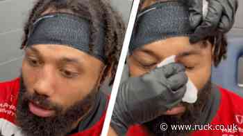 "it's still dented isn't it" - Video of Gloucester star getting his nose fixed goes viral - RUCK.co.uk