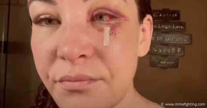 Video: Miesha Tate takes out her own stitches from UFC Vegas 43 loss: ‘Who needs a doctor!?’