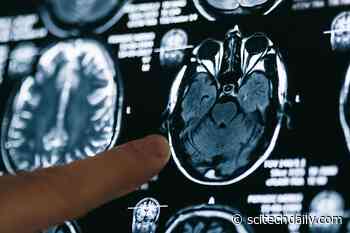 COVID-19 Can Infect Nerve Cells and Cause a Range of Neurological and Psychiatric Symptoms
