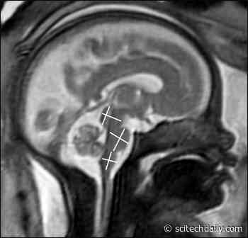 Does COVID-19 During Pregnancy Harm the Baby’s Brain?