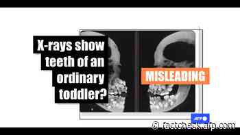 Images show X-rays taken from a US medical journal's report about girl with rare dental condition - AFP Factcheck