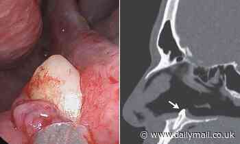 Man finds tooth in his NOSE in rare case of an 'ectopic tooth' that affected ability to breathe 