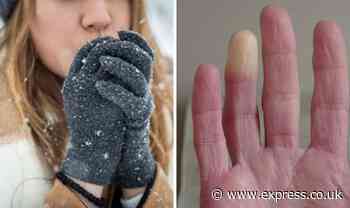 Cold hands symptom checker: The five worrying signs of Raynaud’s