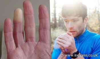 Raynaud's Disease symptoms: Does Raynaud's affect your heart?