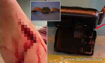 Apple hit with lawsuit over its Watch design that cut plaintiff's arm and sliced a vien
