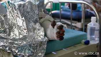 Death toll rising in gas-tanker explosion in Haiti as hospital struggles to treat burn victims