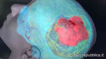 Bari, rimosso un tumore del cranio su un bambino di 7 anni: 14 ore di intervento per ricostruire anche le ossa - La Repubblica
