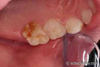 100-Year-Old Mystery of Children’s “Chalky Teeth” Explained – Affects 1 in 5 Children