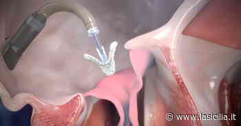 Catania, il Policlinico è il primo centro che opera la valvola tricuspide del cuore senza bisturi - La Sicilia