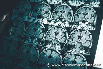 Alzheimer’s Drug Approval Sparks a Firestorm