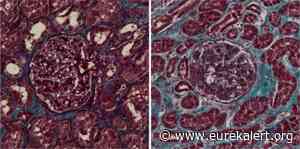Kidney damage as a result of coronavirus infection - EurekAlert