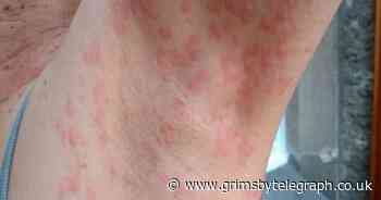 New Omicron symptom could be 'key' to diagnosing Covid variant - Grimsby Live