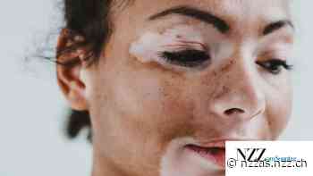 Vitiligo: Helle Flecken auf der Haut, dunkle auf der Seele - NZZ am Sonntag
