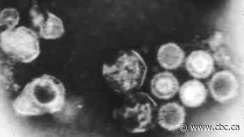 New findings 'strongly suggest' Epstein-Barr virus may help trigger multiple sclerosis