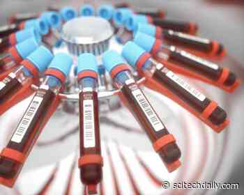 Machine Learning AI Can Predict COVID-19 Survival From Single Blood Test