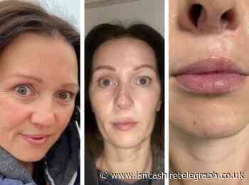 Lancashire mum-of-three with cleft-palate says lip fillers gave her newfound confidence