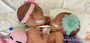 These conjoined twins were separated in a 10-hour surgery — and they’re thriving
