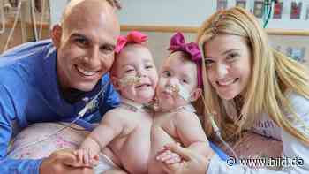 Babys teilten sich Zwerchfell und Leber: Siamesische Zwillinge jetzt getrennt - BILD