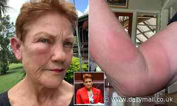 Pauline Hanson sporting swollen eye and large welts across her arms after wasp sting