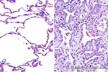 Researchers solve medical mystery of deadly illness in young child – Washington University School of Medicine in St. Louis - Washington University School of Medicine in St. Louis