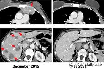 Personalized Immunotherapy Could Potentially Be Used To Treat Metastatic Breast Cancer