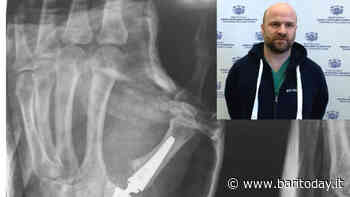 Al Policlinico di Bari una nuova tecnica chirurgica per i pazienti affetti da artrosi del pollice: eseguiti i primi tre interventi - BariToday