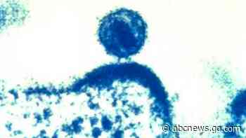 Study identifies virulent HIV variant unrecognized for years