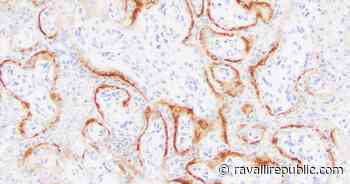 Coronavirus can destroy the placenta and lead to stillbirths - Ravalli Republic