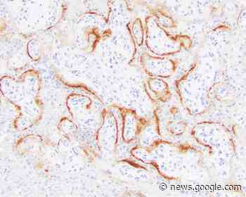 Coronavirus can destroy the placenta and lead to stillbirths - Associated Press