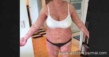 Mother Suffers From Rash After Becoming Pregnant: 'It Was Like I Was Allergic To My Own Baby'