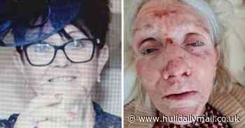Former Miss Hull battered and bruised by falls - now family 'can't sleep' - Hull Live