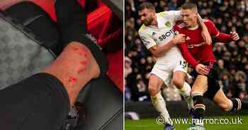Scott McTominay shows off gruesome battle scars from Man Utd's win over Leeds - The Mirror