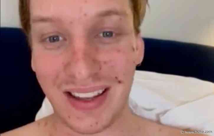 George Ezra reschedules upcoming UK shows after getting chicken pox