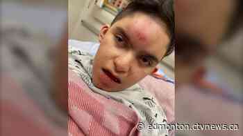 Edmonton boy, 10, has head injuries, broken arms after 'incident' on school bus - CTV News Edmonton